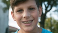 Side Effects of Wearing Braces